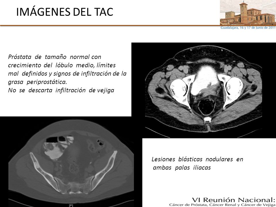 tac adenocarcinoma prostata